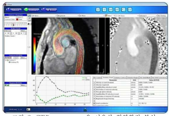 GTflow program을 이용한 혈역학적 분석