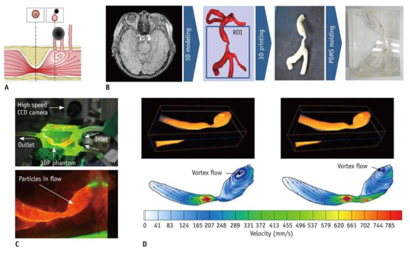 3D-printing과 particle image velocimetry 이용한 두 개 내 혈관 혈류 분석