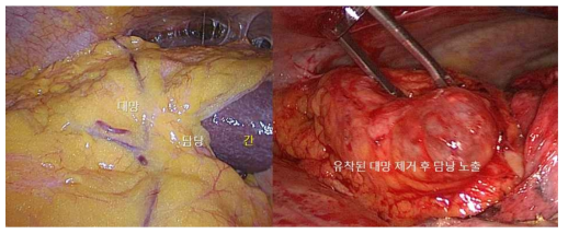 인체 대망조직 채취 과정