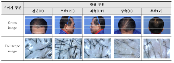 Gross image 및 Folliscope image 예시