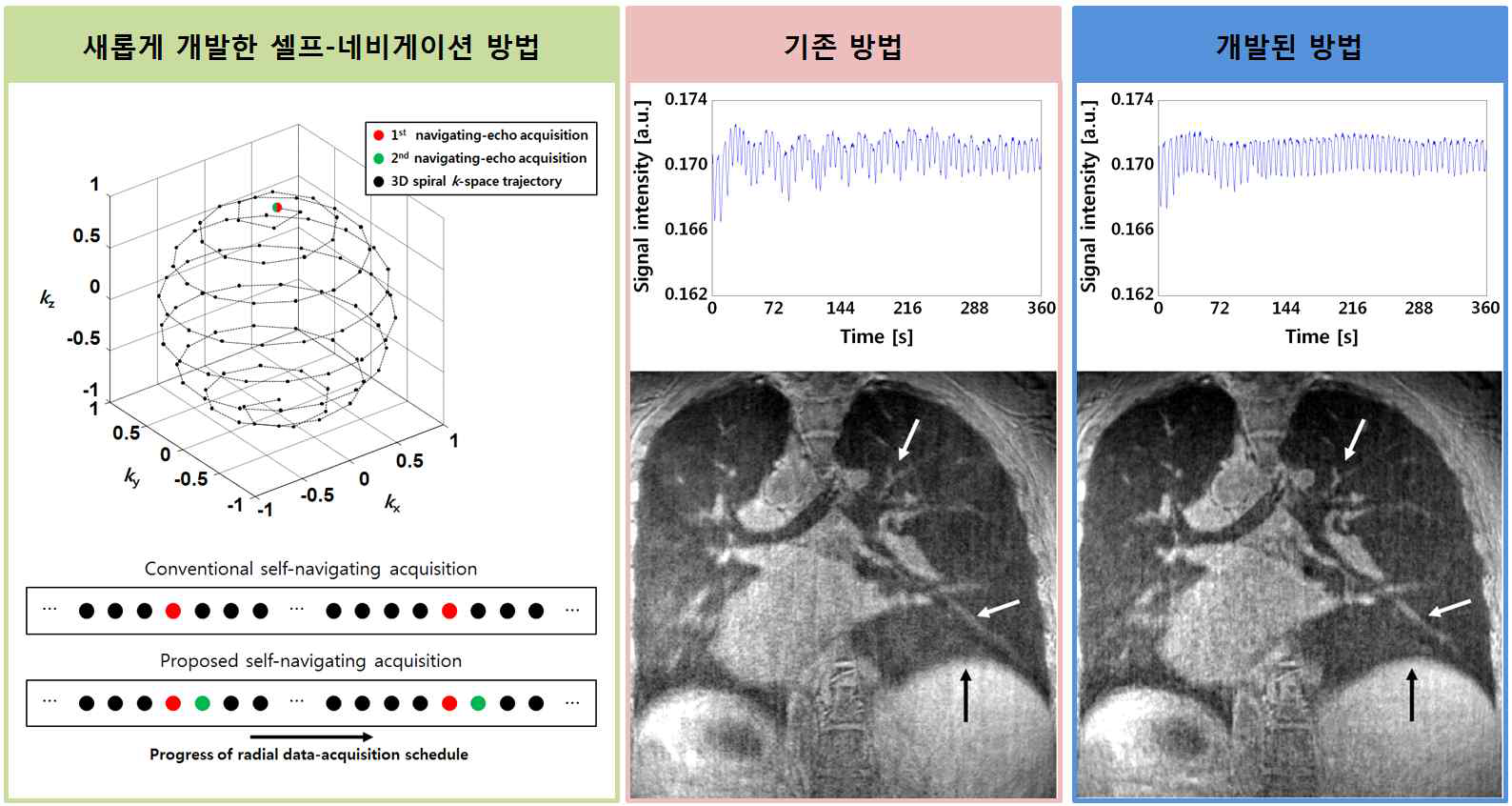 새롭게 개발한 셀프-네비게이션 방법의 획득 방법(왼쪽)과 기존방법과 개발된 방법으로 각각 얻은 호흡 신호와 후향 호흡 게이팅한 폐 영상. 횡경막(검은 화살표), 혈관(하얀 화살표)의 선명함이 증가하여 영상의 SNR이 증가함을 보인다