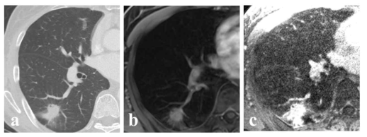 폐암 환자의 CT (a), VIBE (b), CODE (c) 영상. 초기 폐암의 표현형이 CODE 영상에서 특별히 잘 나타나고 있음
