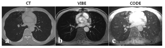 폐 실질 손상 환자의 CT (a), VIBE (b), CODE (c) 영상. CODE 영상을 포함한 MR 영상에서도 폐 실질 손상이 잘 나타남을 알 수 있음