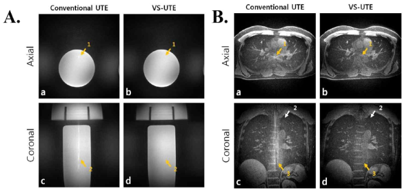 기존의 UTE 영상기법(a, c)과 VS-UTE 영상기법(b, d)을 이용한 팬텀 영상(A)과 in-vivo 폐 영상(B). VS-UTE의 경우, 예상했던 대로 FOV 밖에서 들어오는 신호로 인한 streak artifact가 관찰되지 않음