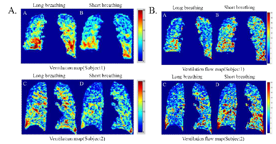 정상인 피험자 두 명의 폐 환기 맵 (Ventilation map) (A), 폐 환기율 맵 (Ventilation flow map) (B)