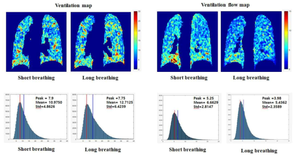 정상인 피험자 두 명의 폐 환기 맵 (Ventilation map), 폐 환기율 맵 (Ventilation flow map), 전체 폐에 대한 폐 환기 히스토그램 분석, 폐 환기율 히스토그램