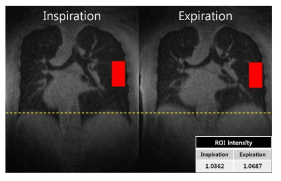 후향 호흡 게이팅을 통해 얻은 흡기와 호기시의 양성자밀도 강조 정상 성인 폐 영상. 대략적인 평가이지만 ROI(빨간색) 내에서 ~3%의 상대적인 신호 차이가 호기와 흡기 시에 나타나는 것을 확인 할 수 있음