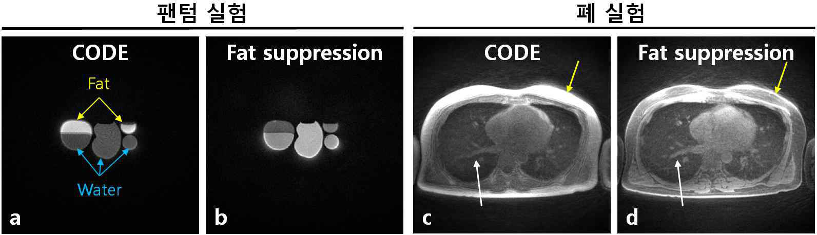 CODE 기법과 스펙트럴 사전인가 펄스를 적용한 CODE 기법을 통하여 얻은 지방-물 팬텀(a, b)과 폐 영상(c, d). 지방 신호 억제 CODE를 사용한 경우 지방조직의 신호가 줄어들음이 확인되고 (c, d 의 노란 화살표), 혈관의 경계선이 명확해진 결과를 볼 수 있음 (c, d의 하얀 화살표)