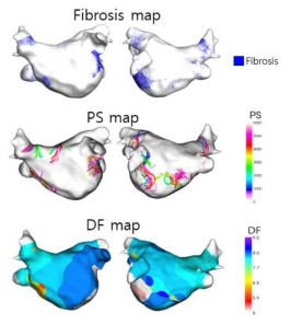 섬유증(fibrosis)이 분포되어 있는 지점에 위상특이점(PS)이 발생하고 있으며, 지배주파수(DF)의 값도 복잡한 형태를 띄고 있음