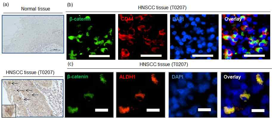 (a) 정상과 암조직에서 Wnt 신호경로 발현 (b, c) Wnt 신호와 줄기세포 표지자의 공동발현