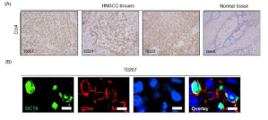 두경부 암 환자조직에서 Oct4 발현