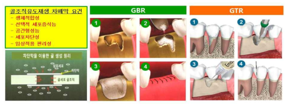 Guided bone regeneration(GBR)과 guided tissue regeneration(GTR). 골유도재생술은 연조직의 증식속도와 골조직의 증식속도 차이를 멤브레인으로 차폐하는 원리를 이용하여 골조직을 재생하는 시술이고, 골조직재생술은 치조골 내부의 연결조직 및 골아세포의 증식을 직접적으로 촉진시키는 치조골 재생술임