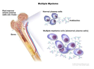 다발 골수종 (Multiple Myeloma; MM)