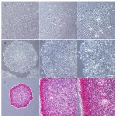 iPSC colony formation from human normal dermal fibroblast. (A) An iPSC colony formed among the fibroblast during the second week of reprogramming. (B) The resulting iPSC colonies showing characteristic morphology with distinct colony border and uniform monolayer cells with large nuclei. (C) AP staining of iPSC colonies stained strong positive staining. These images are taken under phase-contrast microscopy in 5x, 10x, and 20x magnification, left to right, respectively. Scale bar indicates 175, 75, and 37.5 μM, respectively