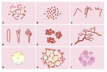 가장 일반적인 정상 혈관 패턴 A-F, G-I 피부암 혈관 패턴의 예 [Zalaudek10a]