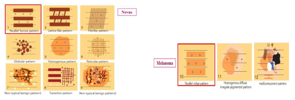 Nevus 와 Melanoma의 다양한 패턴