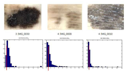 다른 Melanoma 데이터를 인가하였을 때 히스토그램 결과