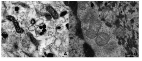 미토콘드리아의 전자현미경 영상 (좌)15세 남자 (우)78세 남자