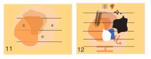 Homogenous diffuse irregular pigmented 패턴과 multicomponent 패턴