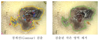 병변 영역 검출