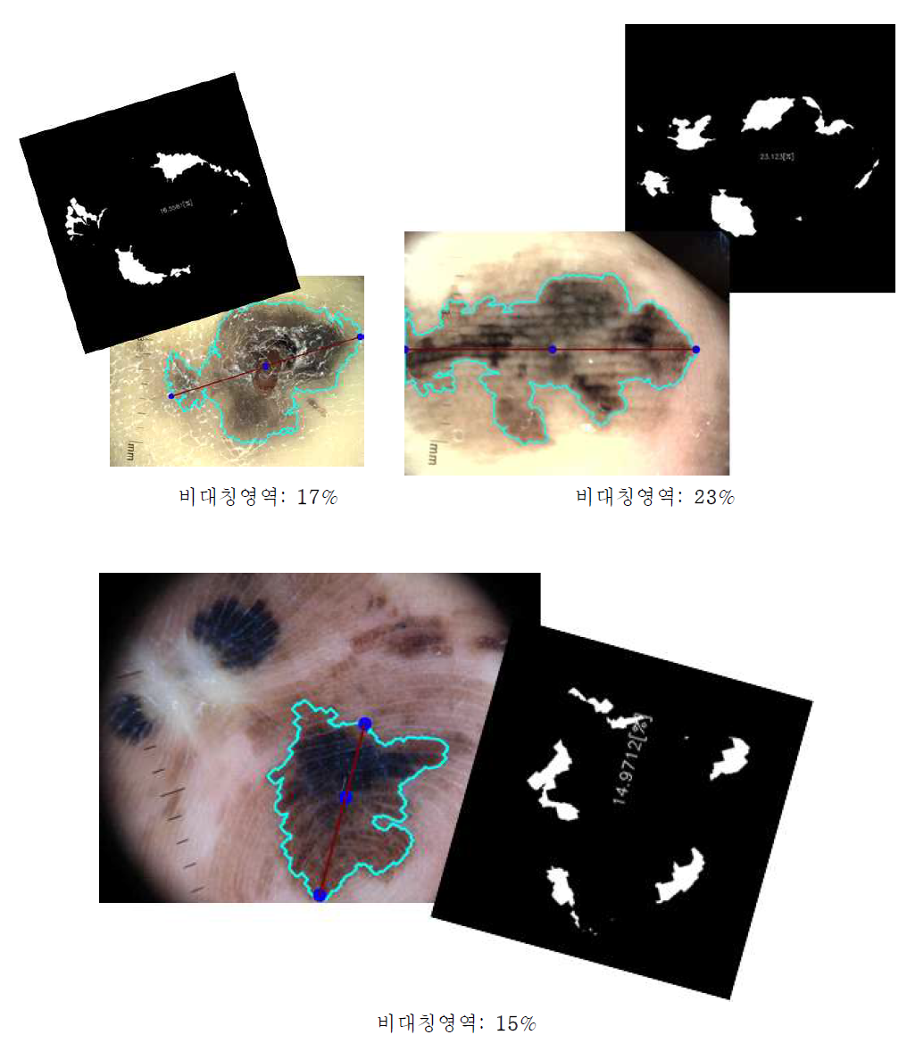 Melanoma의 비대칭성