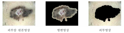 k-means clustering을 이용하여 얻은 피부암 병변 분할 결과