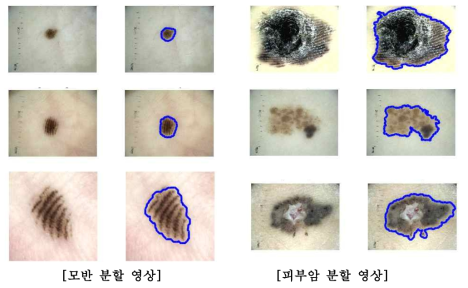 제안한 feature를 사용하여 얻은 피부암 병변 분할 결과