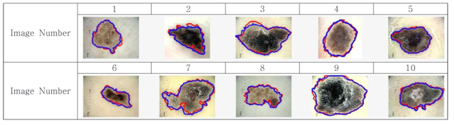 병변 자동분할 영상결과 (Blue line:병변 자동분할 영상결과, Red line : Ground truth )