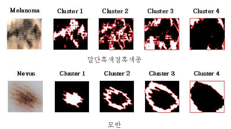 이진화 처리 된 말단흑색점흑색종 및 모반 영상