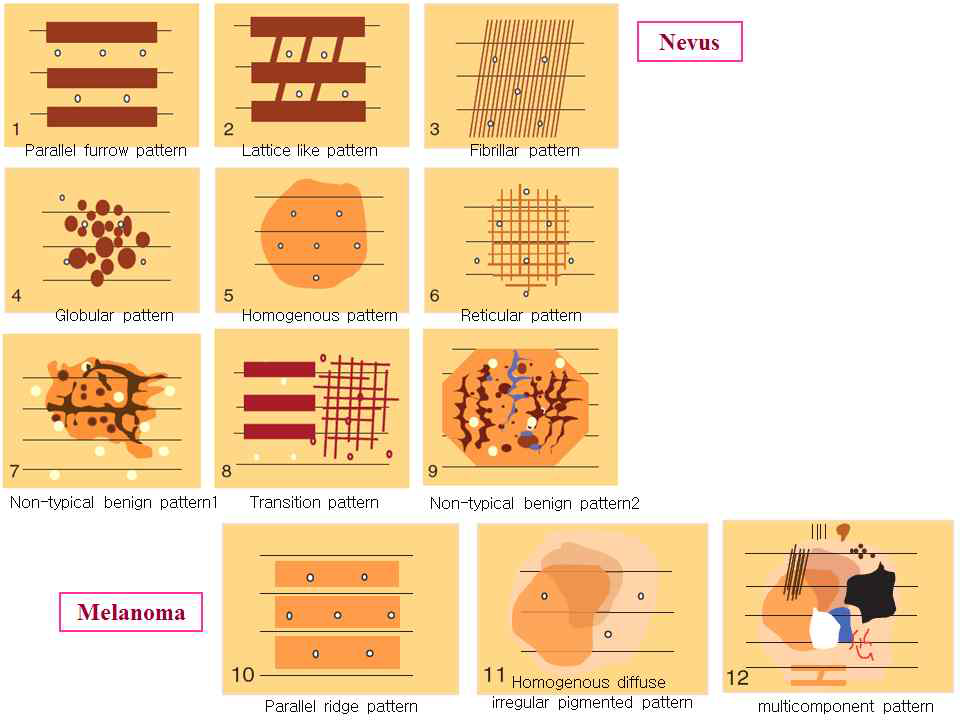 손과 발에 나타나는 nevus와 melanoma 패턴