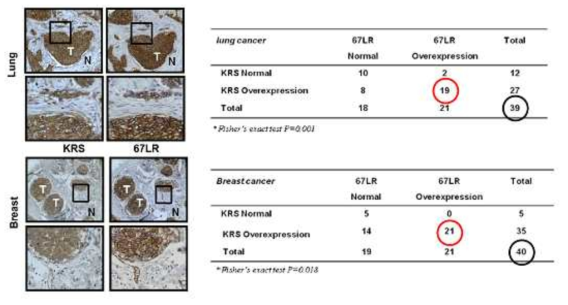 암 조직에서 KRS와 67LR 간의 과발현에 대한 연관성