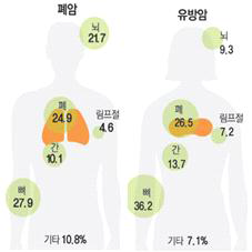 암전이 지도 (서울삼성병원)