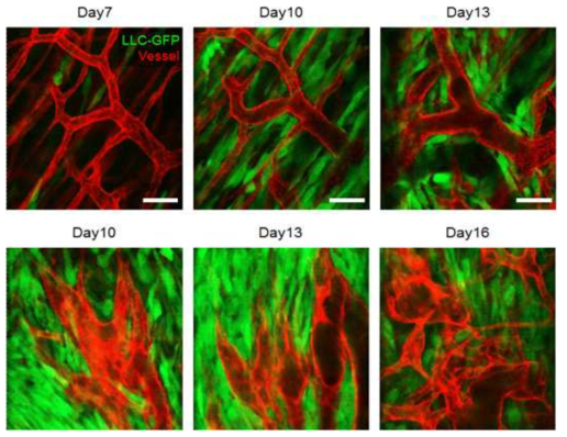 암세포 주변부 및 가장자리의 angiogenesis 관찰 결과