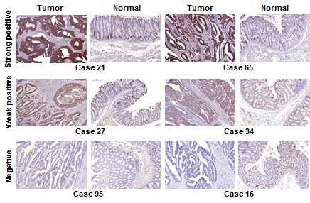 대장암 및 정상조직에서 LRS의 발현 결과