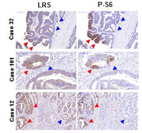 동일 대장암 조직 내 LRS 및 p-S6 발현 결과
