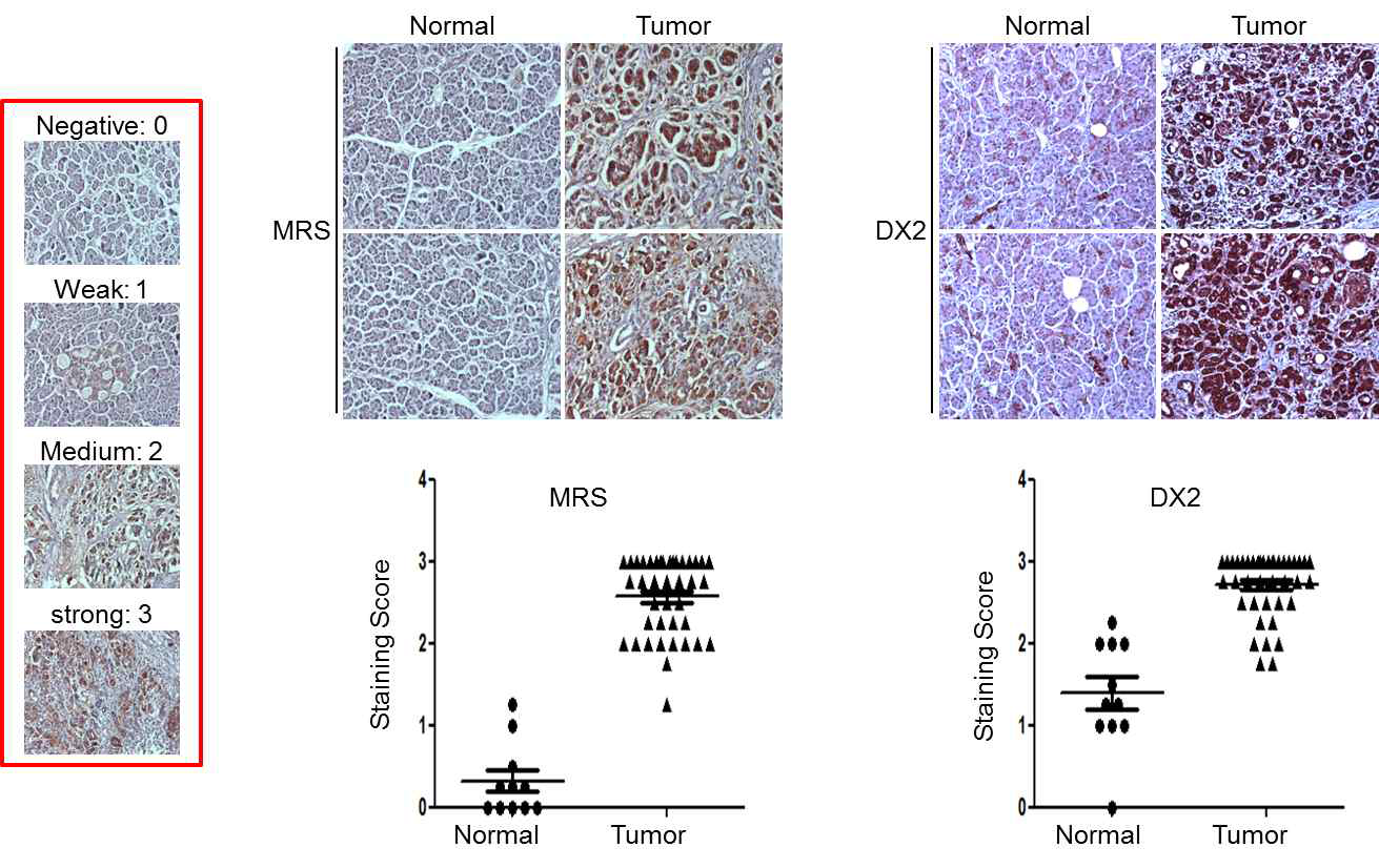 정상 췌장조직과 췌장암 환자 조직에서 MRS 및 AIMP2-DX2 의 발현 확인