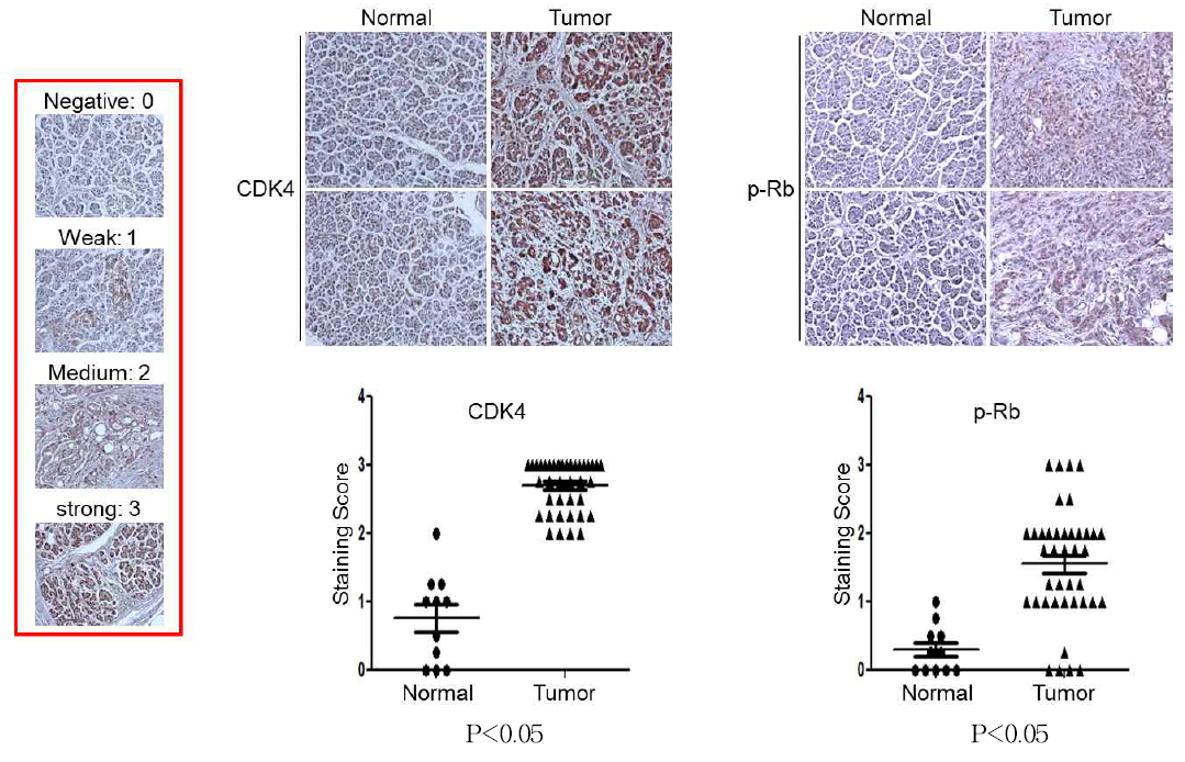 정상 췌장조직과 췌장암 환자 조직에서 CDK4 및 p-Rb 의 발현 확인