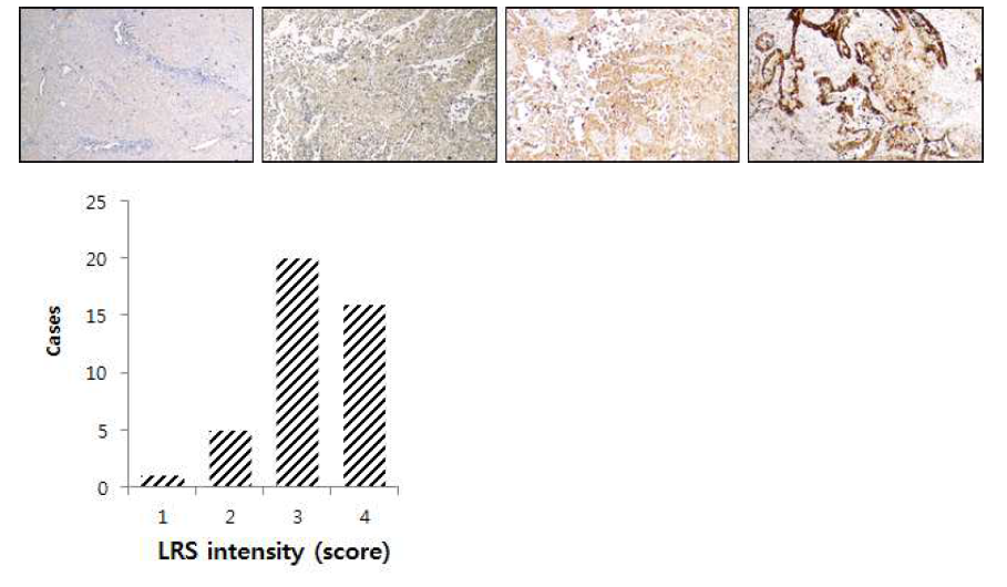 폐암 조직에서 LRS 의 발현과 발현 강도의 분포