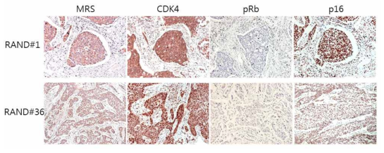 비소세포폐암 조직에서 MRS, CDK4, pRb (ser780) 및 p16의 발현