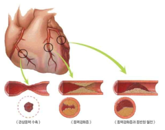 심근경색