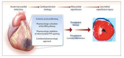 재관류 요법과 동시에 허혈 손상을 최소화하고 경색 크기를 감소시킬 수 있는 심 보호 치료의 중요성
