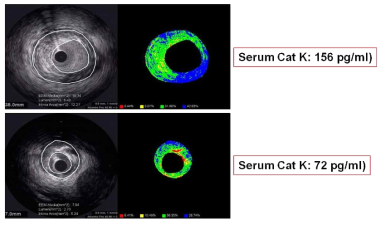 관동맥초음파 영상과 CatK와의 관계. 관동맥 동맥경화반의 지질면적(lipid volume)이 많은 환자에서 CatK의 혈중 농도가 상승됨을 알 수 있음