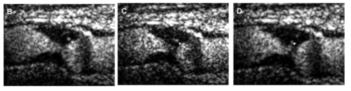조영증강 초음파로 촬영한 경동맥 동맥경화반내의 신생혈관을 촬영한 사진. 화살표는 미세 bubble이 신생혈관을 따라서 동맥경화반 내로 들어가고 있는 모습을 촬영한 모습