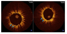 관동맥 스텐트 시술 직후(좌)와 3개월 후 재내피재생화가 이루어진 모습(우)