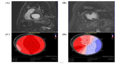 심장 MRI 와 조영증강 심초음파 사진. Exenatide 투여군 (A,C)에서 대조군(B,D)에 비해 심근경색 크기가 감소됨을 알 수 있음