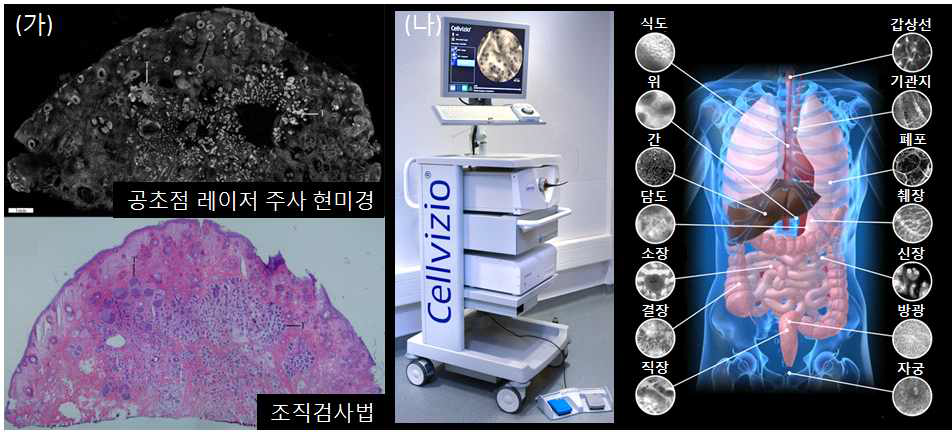 (가) 간의 고분해능 광학 현미경 영상 (나) 상용 내시현미경을 이용한 질병 진단 사례