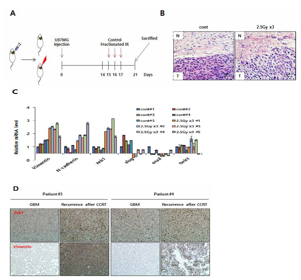 분할 방사선 조사 후 동물모델과 환자 뇌암조직에서 중간엽성 세포전환 및 전이능 획득