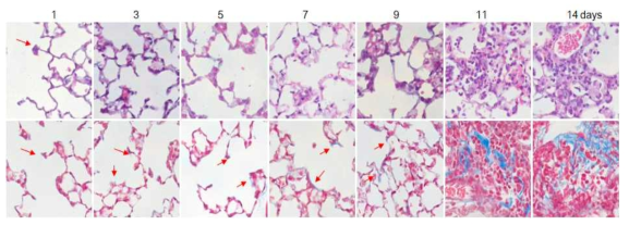 방사선 조사 후 alveolar septal tip 부분에 부종이 생기고 (화살표) 이 부분 들이 합쳐서 alveolar destruction이 일어나면서 air way가 점차 좁아지는 것을 확인함. collagen을 나타내는 trichrome stain에서도 septal tip과 septa가 연결된 부분에서 positive (파란색) signal이 증가함을 확인하고 11일 이후 섬유화 부분에서는 collagen의 발현이 현저히 증가함. (1 day의 경우 방사선 조사를 받지 않은 정상 페조직과 동일한 조직학적 소견을 보임)