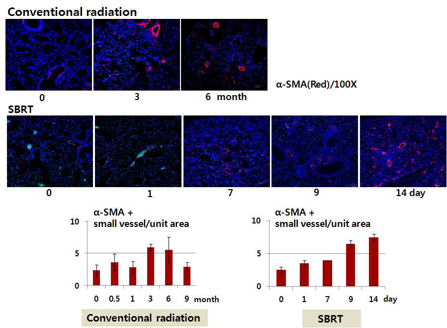 제 4 세부과제로부터 통상적 방사선 조사 (Conventioanl Radiotherapy, 20 Gy)를 받은 마우스의 폐조직과 체부정위 방사선 조사 (SBRT; Stereotactic body radiation therapy, 90 Gy, 3 mm Collimator)를 받은 마우스의 폐조직을 제공받아 α-SMA (Red)와 DAPI (Blue)로 형광 염색하여 관찰한 결과, 방사선 조사 후 α-SMA (Red)가 닫힌 원의 형태로 두텁게 염색되는 것을 통해 소혈관이 형성된 것으로 보임. 이러한 소혈관은 체부정위 방사선 조사 (SBRT)를 받은 마우스의 폐에서 섬유화가 진행되는 과정에서 더 많은 빈도로 관찰됨. 이러한 소혈관 생성 과정에 대한 연구는 거의 이루어져있지 않으나, 본 연구에서는 방사선에 의한 폐섬유화과정에서 소혈관생성의 뚜렷한 현상이 큰 의미를 가지고 있을 것으로 제안하며, 폐섬유화가 진행되는 과정에서 나타나는 wound healing process 로 나타나는 현상인지, 섬유화 진행에서 어떠한 역할을 하기 위한 과정인지 구체적인 연구를 진행하고자 합