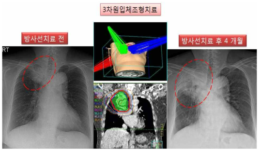 실제 임상 예 환자로 60 이시며, 방사선치료를 3 차원입체조형치료법으로 66 Gy 까지 시행하여, 우측 폐 상엽에 있던 종괴는 사라졌으나, 연이어 종양이 있던 부위 및 주변 정상조직에 심각한 기침 및 호흡곤란 증상을 동반한 방사선폐렴 발생을 상기 그림에서 보여주고 있음. 좌측 그림 - 치료 전, 가운데 그림 - 방사선치료 계획, 우측 그림 - 방사선조사 부위 발생한 폐렴 및 폐 섬유화